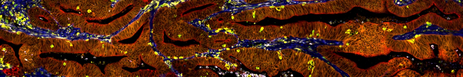 Close-up multiplex immunofluorescence image of colorectal carcinoma tissue, with orange epithelial structures, blue stroma, and yellow immune cells.