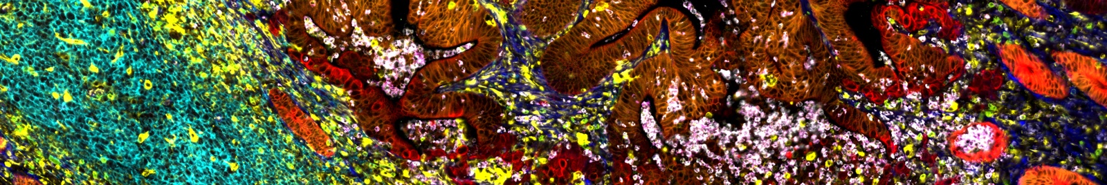 Multiplex image of colorectal tissue with contrasting orange epithelium and blue stroma, pink immune cells, and a cyan lymphoid region at the left edge.